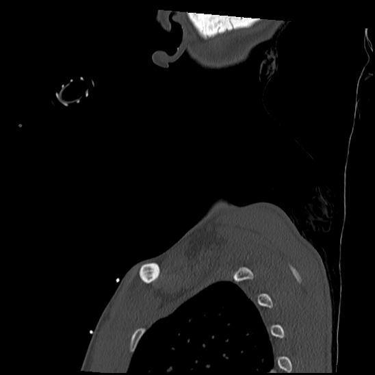 Atlanto-occipital dissociation (Traynelis type 1), C2 teardrop fracture, C6-7 facet joint dislocation (Radiopaedia 87655-104061 Sagittal bone window 70).jpg