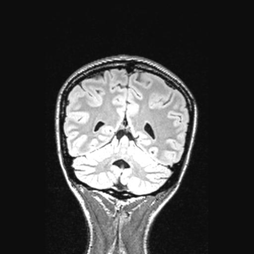 Atretic encephalocoele with inferior vermis hypoplasia (Radiopaedia 30443-31108 Coronal FLAIR 56).jpg