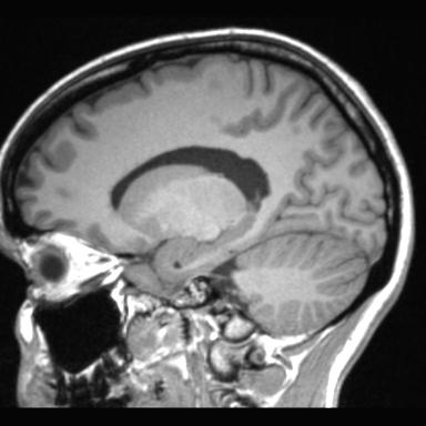 File:Atretic encephalocoele with inferior vermis hypoplasia (Radiopaedia 30443-31108 Sagittal T1 50).jpg