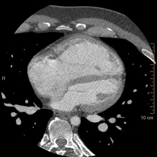 Atrial septal defect (upper sinus venosus type) with partial anomalous pulmonary venous return into superior vena cava (Radiopaedia 73228-83961 A 157).jpg