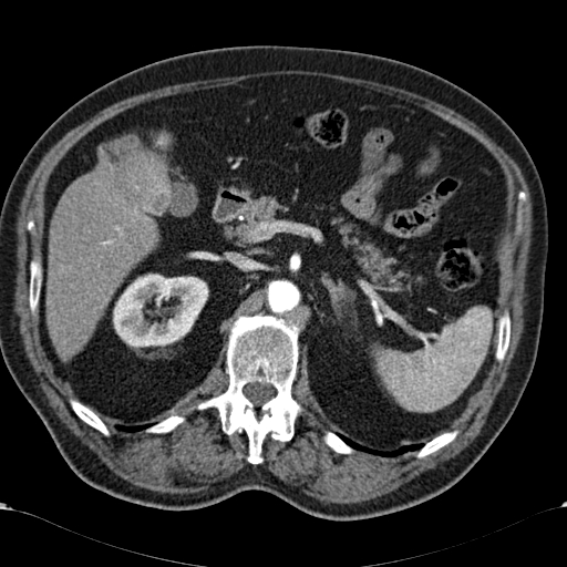 Atypical hepatocellular carcinoma (Radiopaedia 41744-44698 A 37).jpg