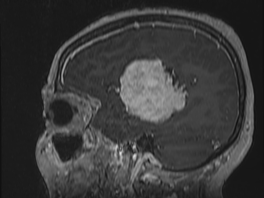 Atypical meningioma (Radiopaedia 62985-71406 Sagittal T1 C+ 70).jpg