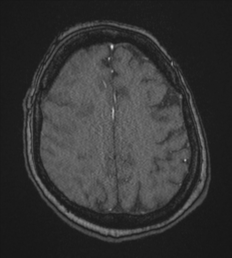 Atypical meningioma (WHO Grade II) (Radiopaedia 54742-60981 Axial MRA 74).png