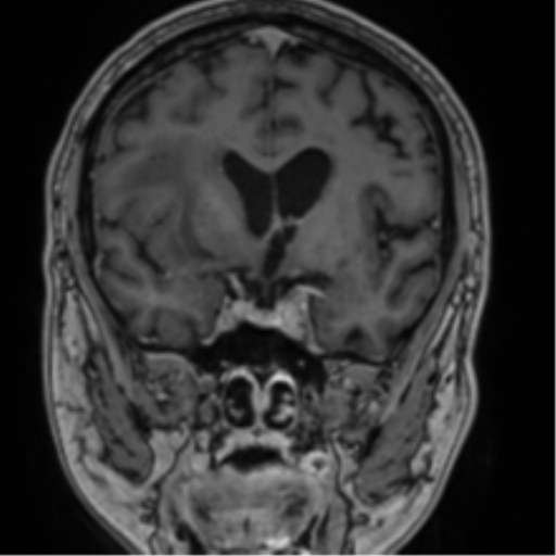 Atypical meningioma (WHO grade II) with brain invasion (Radiopaedia 57767-64729 Coronal T1 C+ 36).png