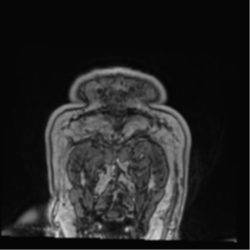 Atypical meningioma (WHO grade II) with brain invasion (Radiopaedia 57767-64729 Coronal T1 C+ 89).png