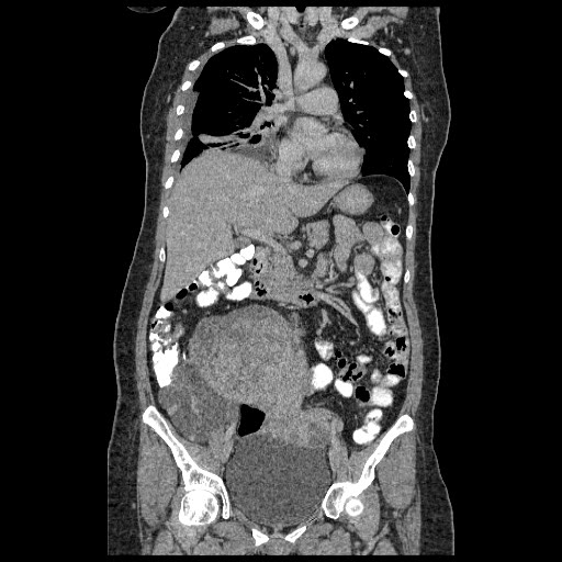 File:Atypical retroperitoneal lymphocoeles with large leiomyoma of uterus (Radiopaedia 32084-33024 B 10).jpg