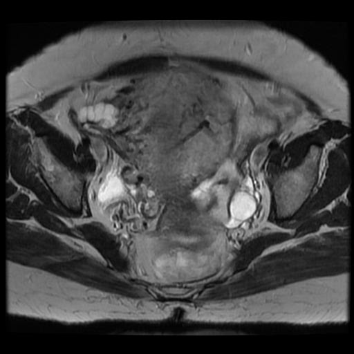 File:Atypical retroperitoneal lymphocoeles with large leiomyoma of uterus (Radiopaedia 32084-33027 Axial T2 21).jpg
