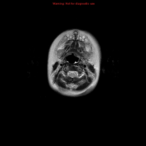 File:Atypical teratoid rhabdoid tumor (Radiopaedia 10712-11183 Axial T2 19).jpg
