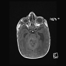 File:Atypical teratoid rhabdoid tumor (prenatal US and neonatal MRI) (Radiopaedia 59091-66388 Axial T1 22).jpg