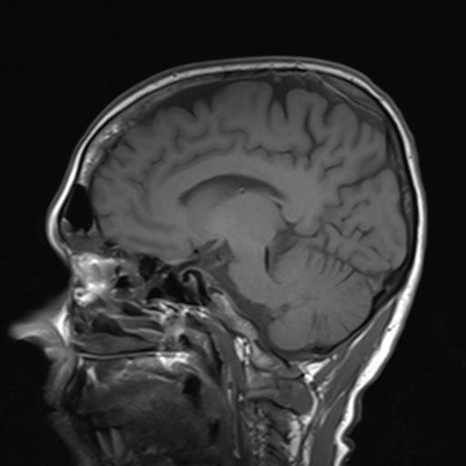 File:Autoimmune limbic encephalitis (Radiopaedia 30363-31005 Sagittal T1 15).jpg