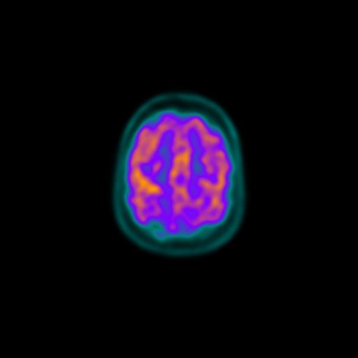 File:Autoimmune limbic encephalitis (Radiopaedia 30363-31009 B 7).jpg