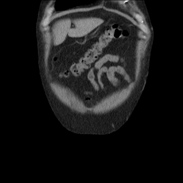 Autosomal dominant polycystic kidney disease (Radiopaedia 36539-38101 C 10).jpg