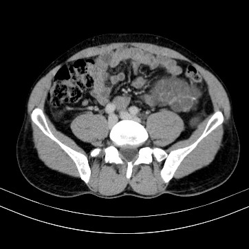 Autosomal dominant polycystic kidney disease (Radiopaedia 66349-75582 B 71).jpg