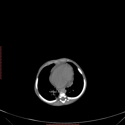 Autosomal recessive polycystic kidney disease associated with Caroli disease (Radiopaedia 61932-69984 B 88).jpg