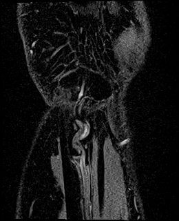 Avascular necrosis of the capitate (Radiopaedia 88317-104948 Coronal T1 vibe 88).jpg