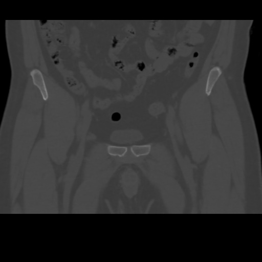 File:Avascular necrosis of the hip (Radiopaedia 61503-69467 Coronal bone window 2).jpg