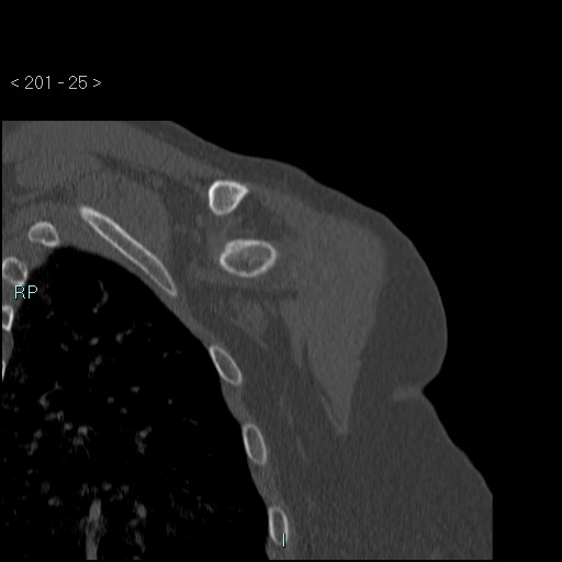Avascular necrosis of the shoulder - Cruess stage I (Radiopaedia 77674-89887 Coronal bone window 24).jpg