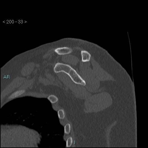 Avascular necrosis of the shoulder - Cruess stage I (Radiopaedia 77674-89887 Sagittal bone window 32).jpg