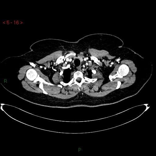Azygos fissure and lobe (Radiopaedia 47620-52278 A 2).jpg