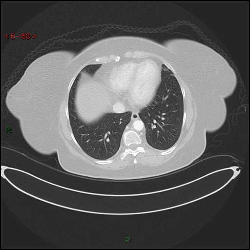 Azygos fissure and lobe (Radiopaedia 47620-52278 Axial lung window 68).jpg