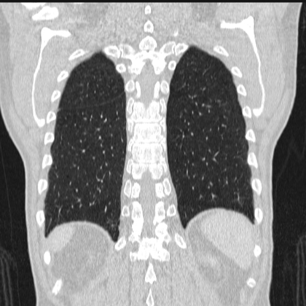 Azygos lobe (Radiopaedia 38259-40275 Coronal lung window 64).jpg