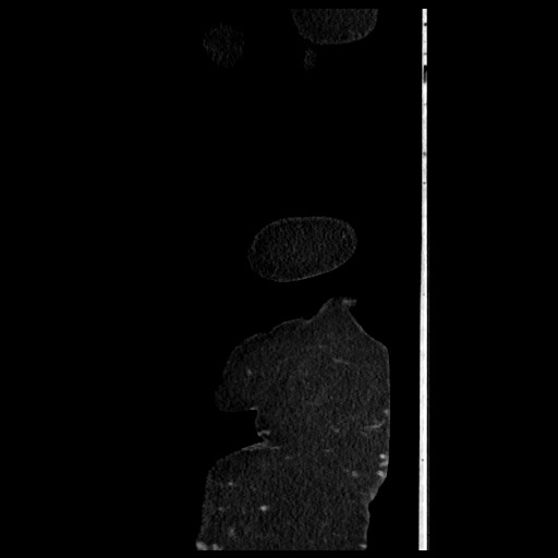 B-cell lymphoma of the mesentery (Radiopaedia 65711-74827 C 15).jpg