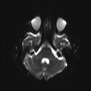 Balo concentric sclerosis (Radiopaedia 50458-55940 Axial DWI 17).jpg