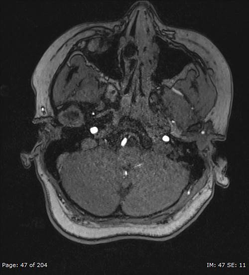 Balo concentric sclerosis (Radiopaedia 61637-69636 Axial MRA 47).jpg