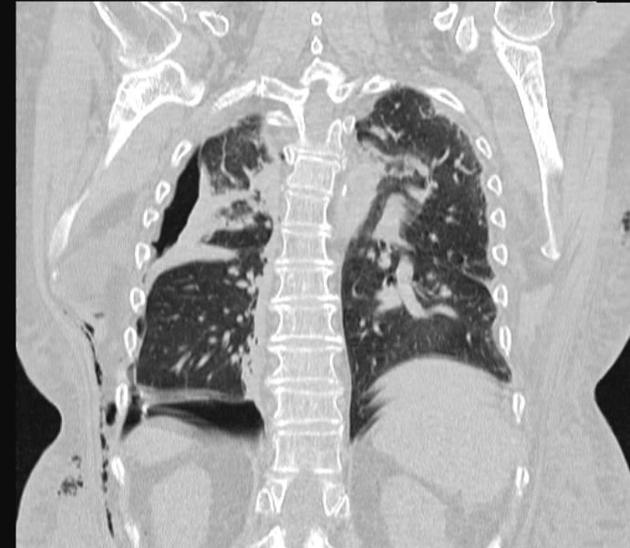 Barotrauma due to mechanical ventilation (Radiopaedia 28079-28336 Coronal lung window 69).jpg
