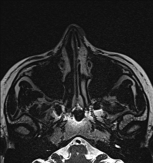 Basal cell carcinoma - nasal region (Radiopaedia 70292-80365 Axial Gradient Echo 25).jpg