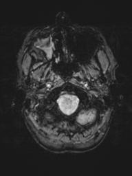 Base of skull chondrosarcoma (Radiopaedia 30410-31070 Axial SWI 5).jpg