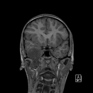 Base of skull rhabdomyosarcoma (Radiopaedia 32196-33142 Coronal T1 16).jpg