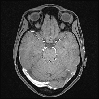 Basilar artery perforator aneurysm (Radiopaedia 82455-97733 Axial T1 fat sat 59).jpg