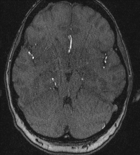Basilar tip aneurysm (Radiopaedia 26504-26632 MRA 86).jpg