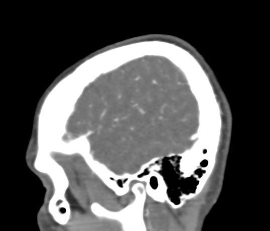 Basilar tip aneurysm with coiling (Radiopaedia 53912-60086 C 14).jpg