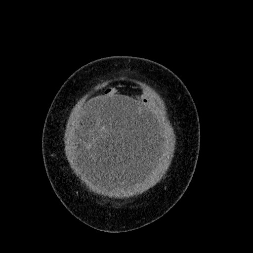 Benign leiomyoma with hydropic features (Radiopaedia 89250-106130 B 13).jpg