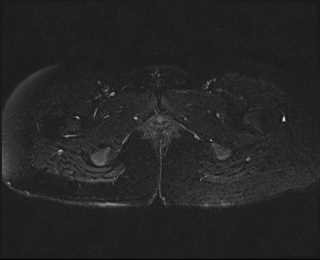 File:Bicornuate bicollis uterus (Radiopaedia 61626-69616 Axial PD fat sat 34).jpg