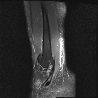 File:Bilateral Achilles tendon complete tear (Radiopaedia 81344-95051 Sagittal T2 fat sat 2).jpg