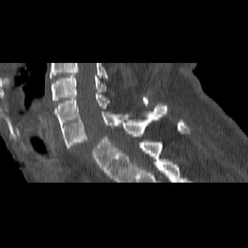 File:Bilateral C6-7 locked facet dislocation (Radiopaedia 28506-28748 Sagittal bone window 9).jpeg