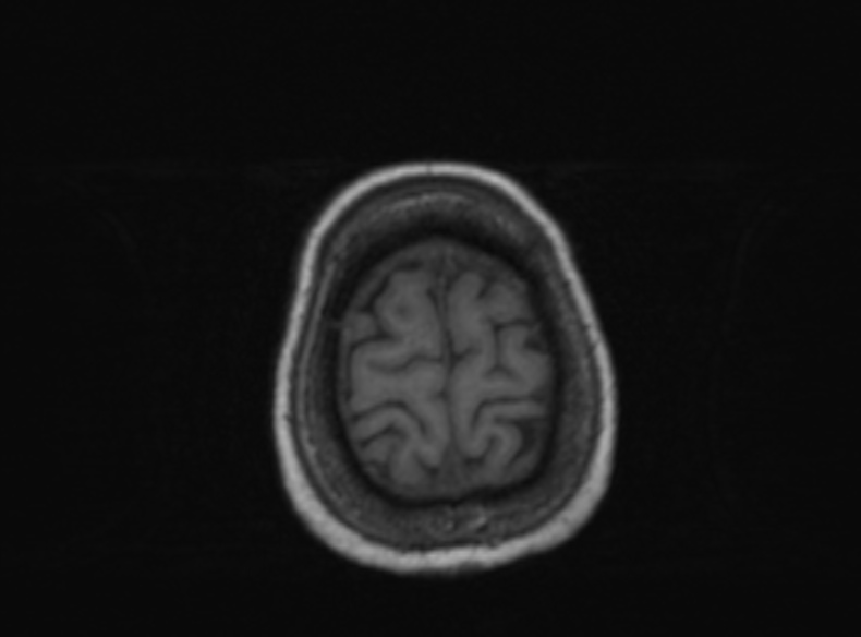 File:Bilateral PCA territory infarction - different ages (Radiopaedia 46200-51784 Axial T1 131).jpg