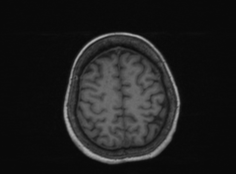Bilateral PCA territory infarction - different ages (Radiopaedia 46200-51784 Axial T1 158).jpg