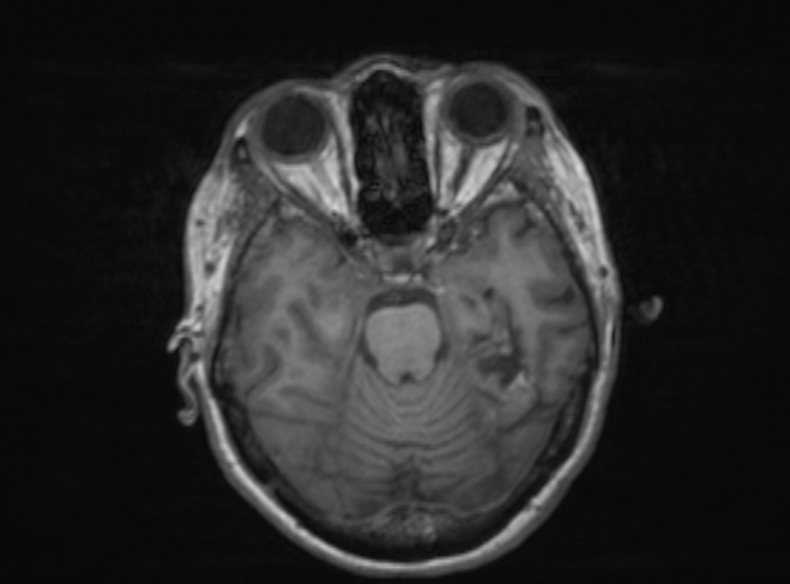 Bilateral PCA territory infarction - different ages (Radiopaedia 46200-51784 Axial T1 279).jpg