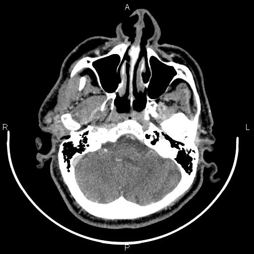 Bilateral Warthin tumors (Radiopaedia 84034-99263 Axial With contrast 9).jpg