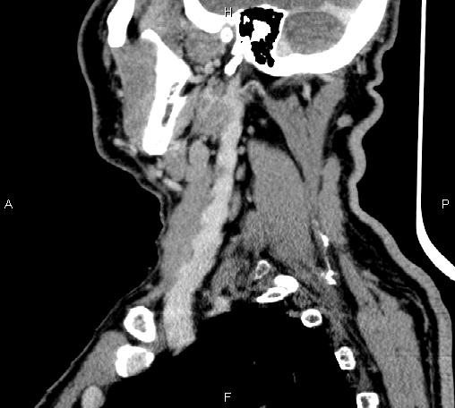 Bilateral Warthin tumors (Radiopaedia 84034-99263 D 27).jpg