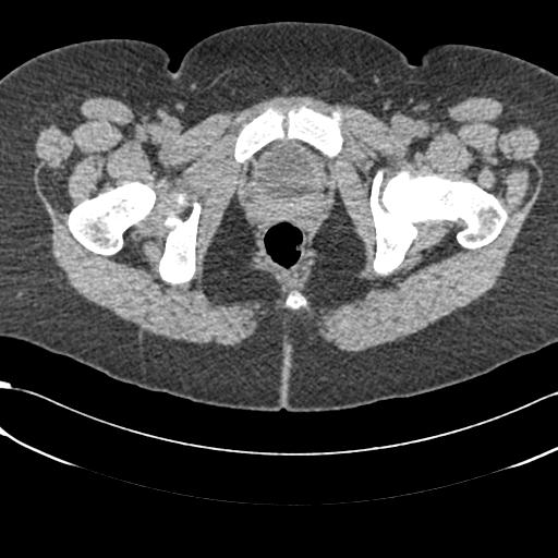 Bilateral acetabular protrusion with pincer type femoro-acetabular impingement (Radiopaedia 30134-30733 AXIAL SOFT THIN 68).jpg