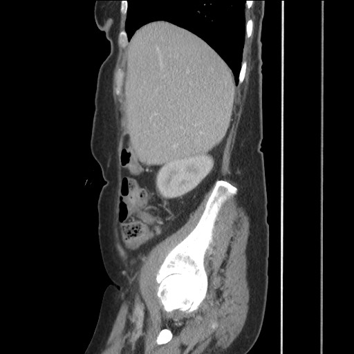 Bilateral adrenal granulocytic sarcomas (chloromas) (Radiopaedia 78375-91007 C 42).jpg