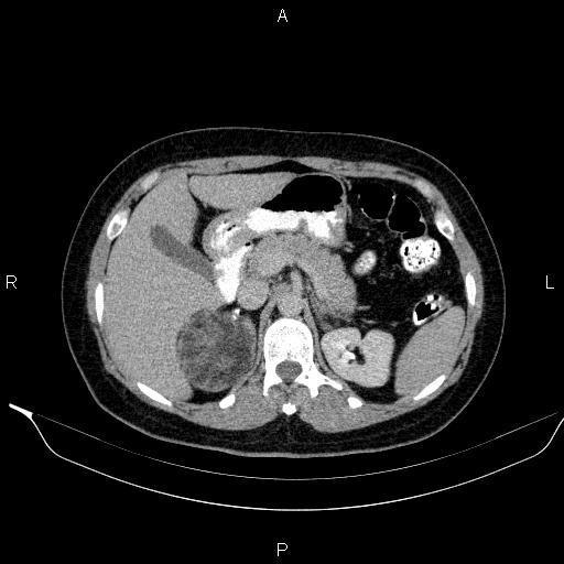 Bilateral adrenal myelolipoma (Radiopaedia 63058-71535 Axial C+ delayed 28).jpg