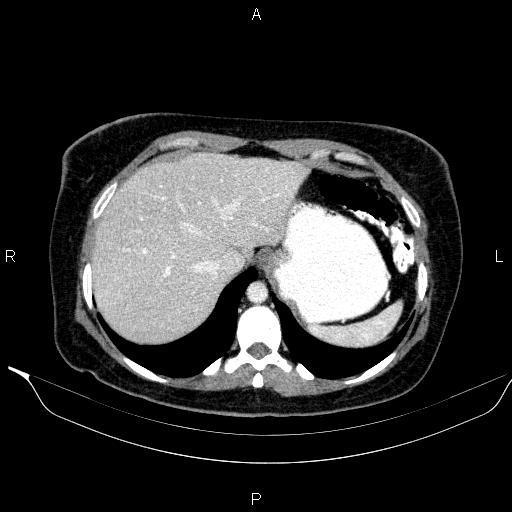 File:Bilateral adrenal myelolipoma (Radiopaedia 63058-71535 B 25).jpg