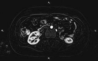 Bilateral adrenal myelolipoma (Radiopaedia 63058-71537 I 54).jpg