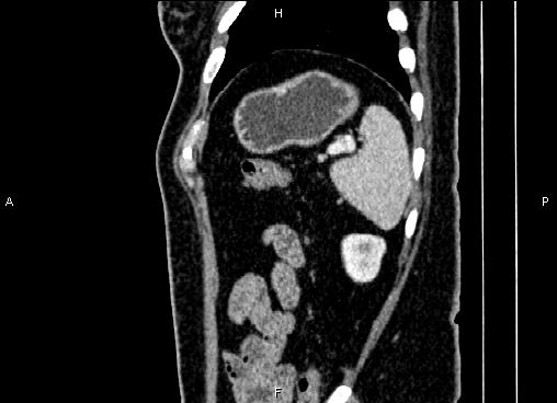 Bilateral benign adrenal adenomas (Radiopaedia 86912-103124 E 85).jpg
